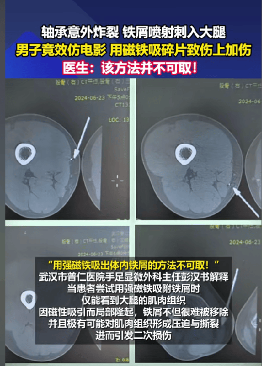 男子用磁铁吸扎腿铁屑 伤上加伤，医生提醒盲目使用强磁铁可能导致二次伤害